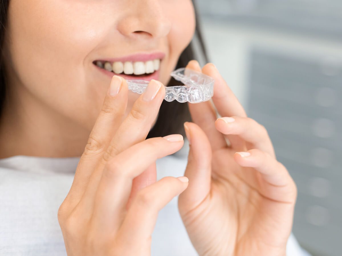 FAS Aligner System - Aligners