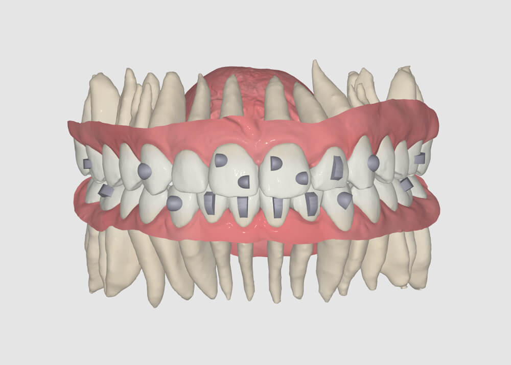 FAS Aligner System - FAS Occusal Design