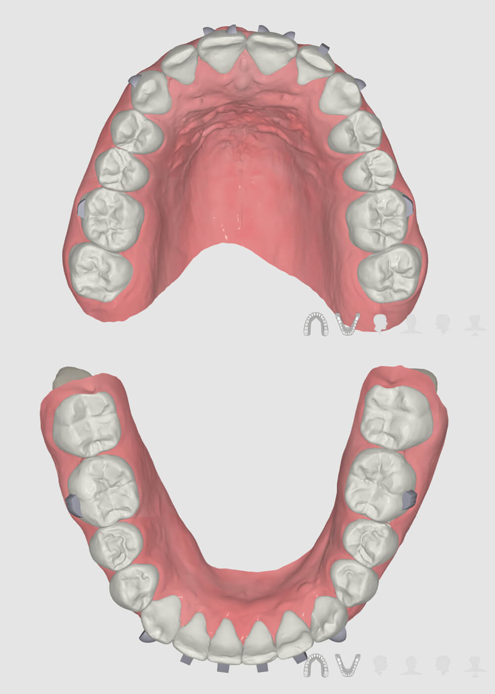 FAS Aligner System - FAS Occusal Design