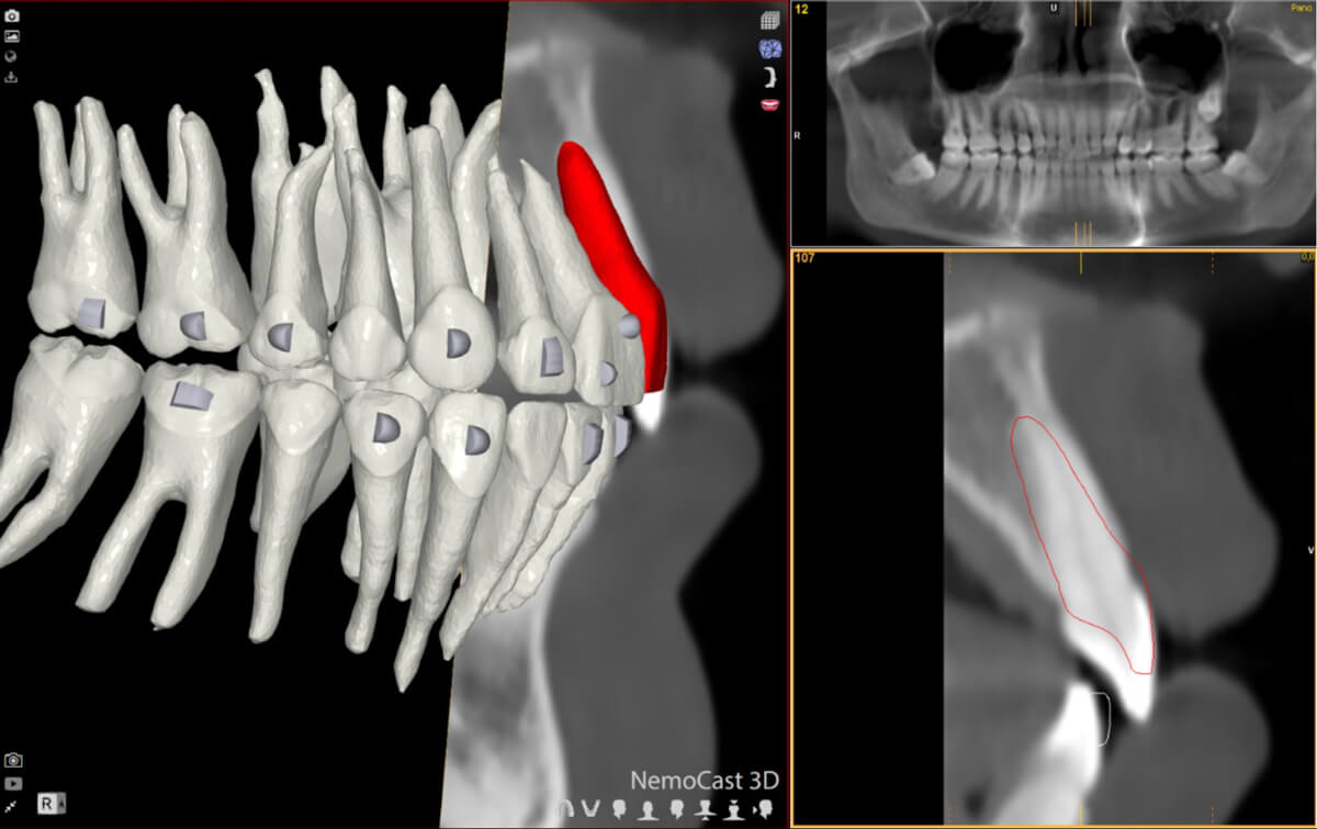 FAS Aligner System - FAS Occusal Design