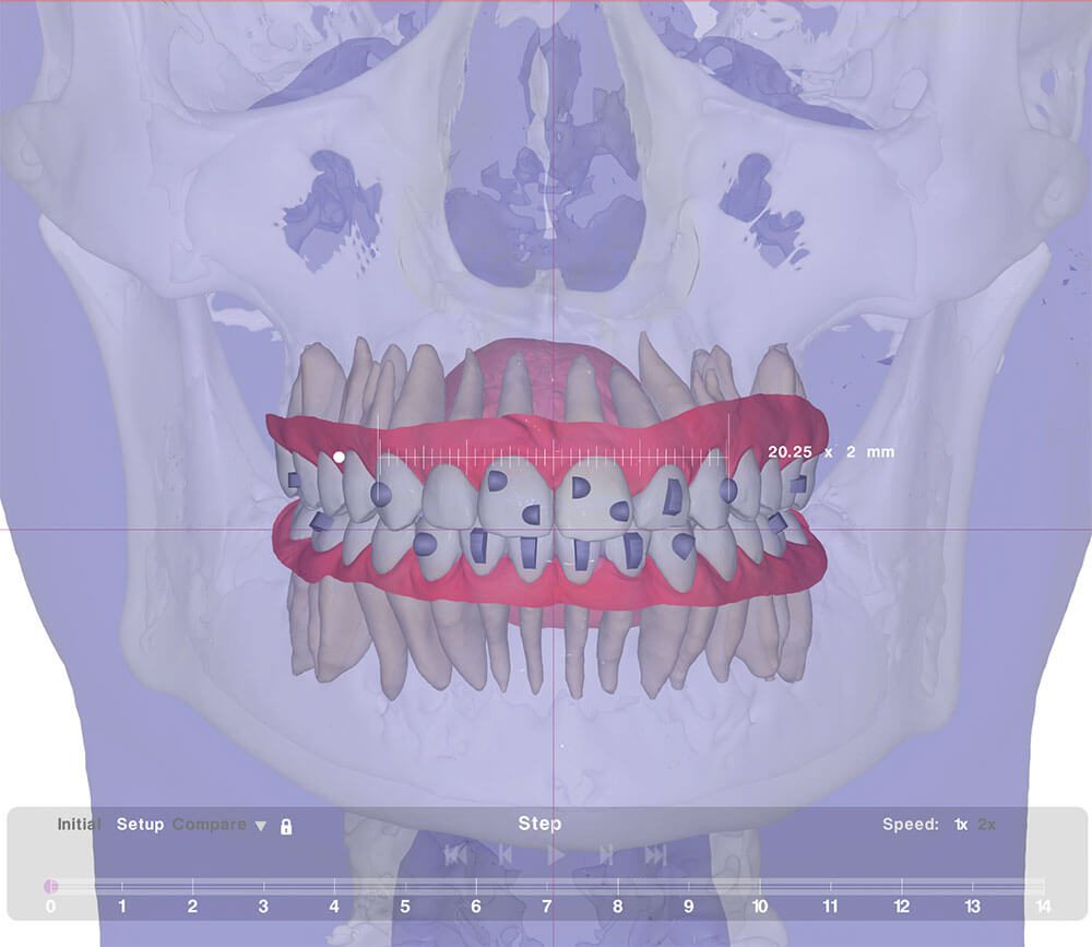 FAS Aligner System - Elementi Diagnostici