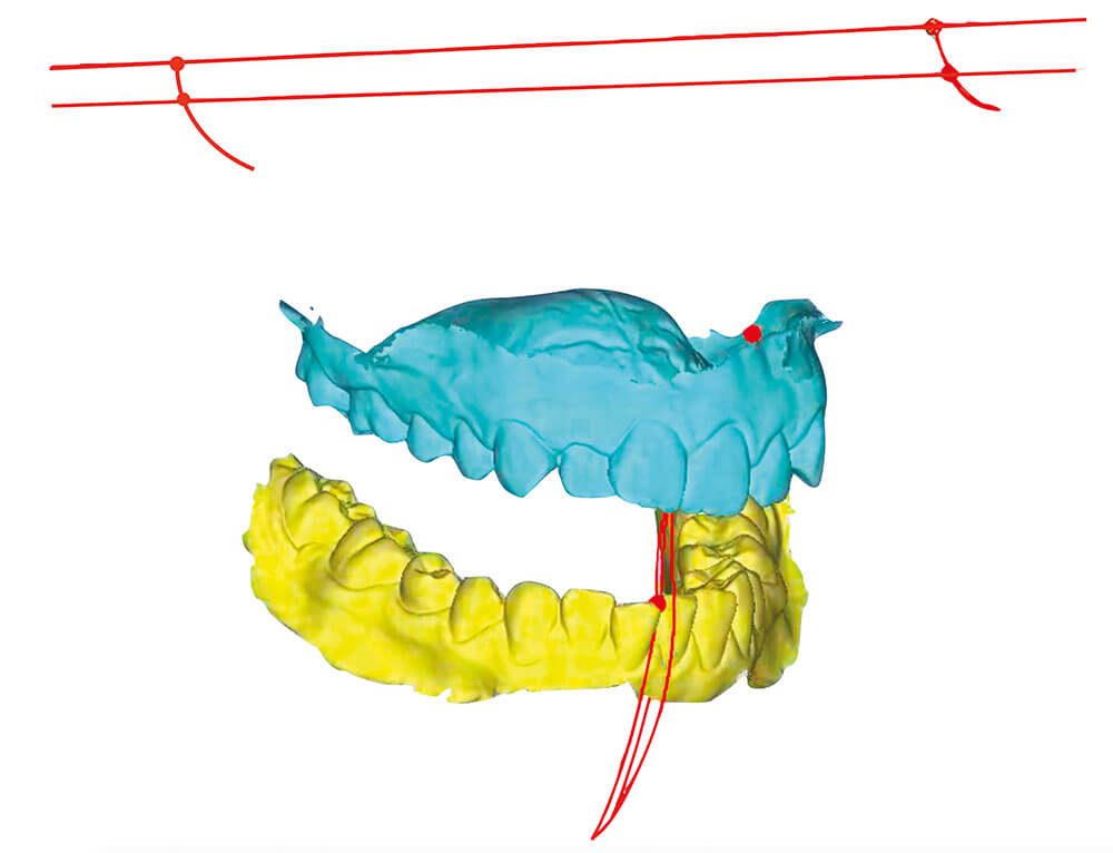 FAS Aligner System - Éléments de Diagnostic