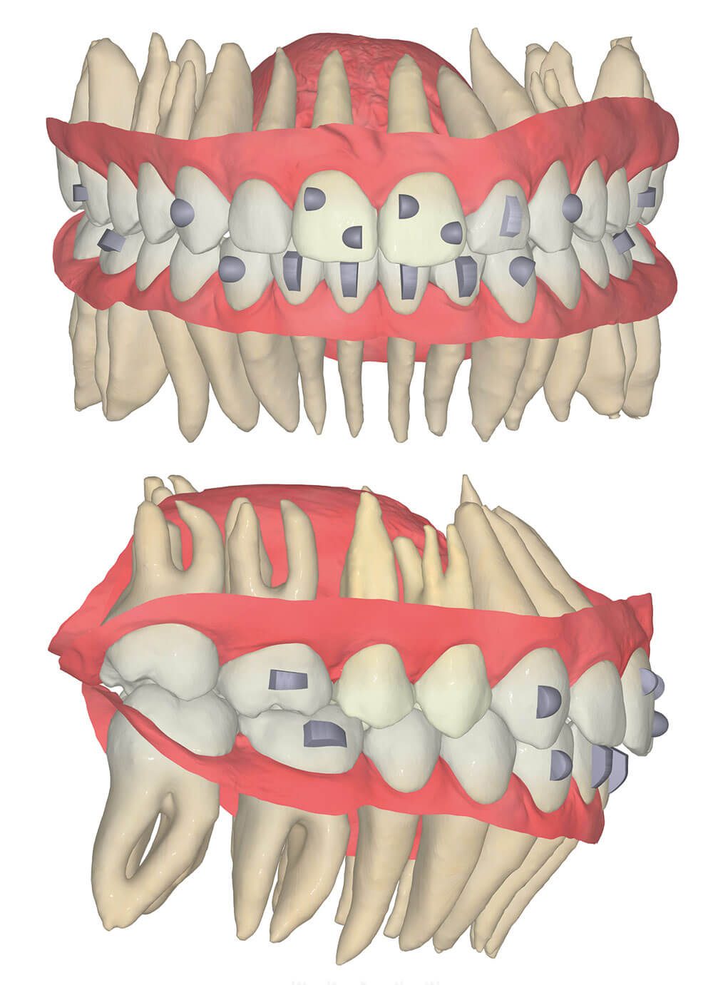 FAS Aligner System - FAS Occusal Design