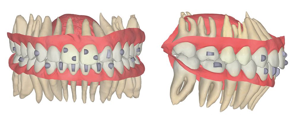 FAS Aligner System - FAS Occusal Design